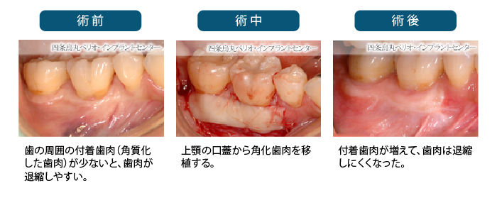 遊離歯肉移植術