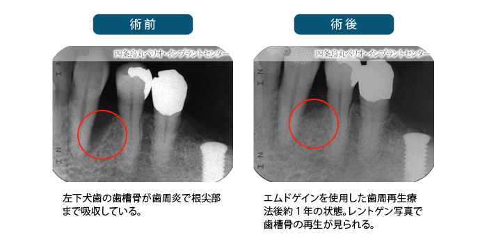 再生療法