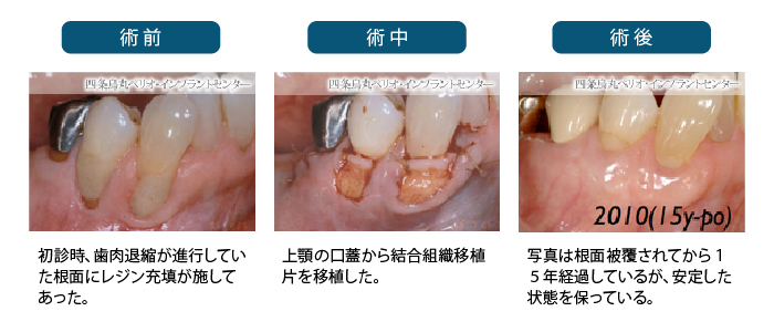 根面被覆術